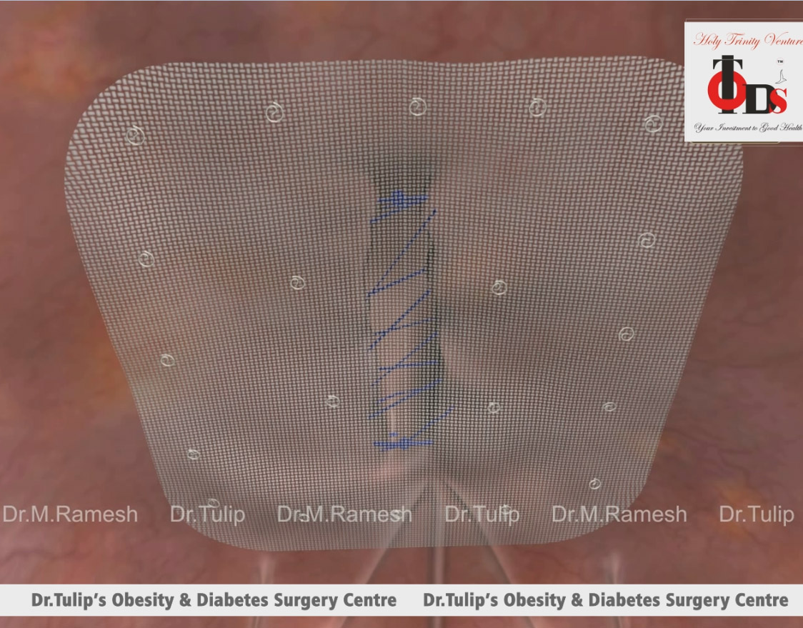  Open surgery Hernia